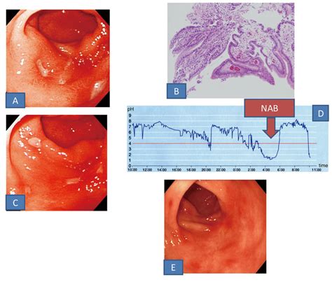 A Upper Gastrointestinal Endoscopic Findings Small Ulcers With Edema