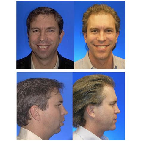 Before And After Photos Maxillofacial Surgery Larry M Wolford Dmd