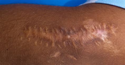 Keloid And Hypertrophic Scars A Narrative Review Of Classifications