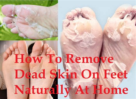 How To Remove Dead Skin On Feet Naturally At Home