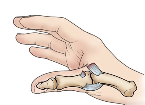 Sprained Thumb Orthoinfo Aaos