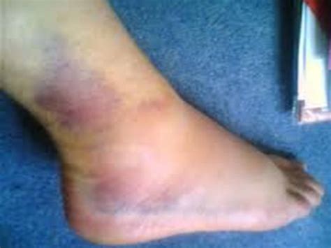 Ankle Sprains Greg Robinson Podiatrist
