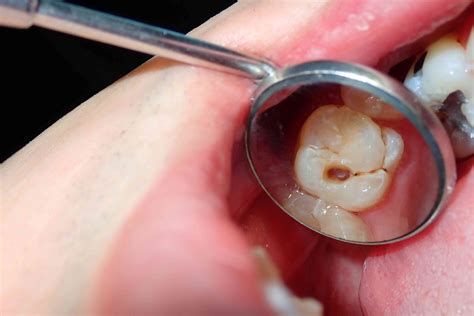 Tooth Decay Stages Complications And Treatment