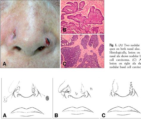 Figure 1 From Combination Nasolabial Transposition Flap And Island