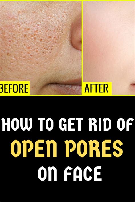 How To Get Rid Of Pore Holes On Nose Howtoermov