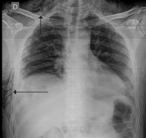 Postoperative Chest X Ray Shows Subcutaneous Emphysema Open I Sexiz Pix