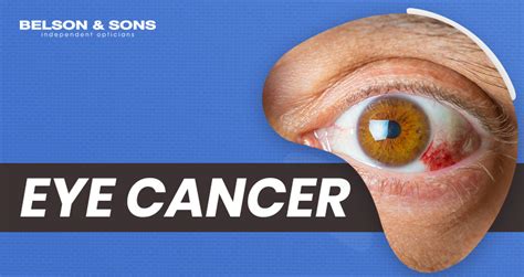 Eye Cancer Symptoms And Treatment