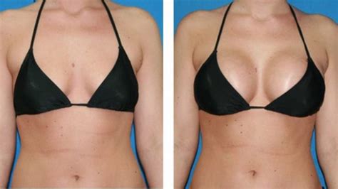 Breast Augmentation What To Expect After Surgery