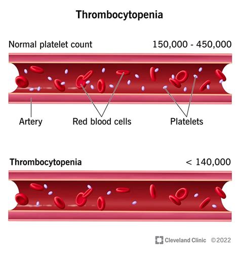 What You Need To Know About Low Blood Platelets Ask The Nurse Expert