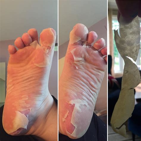 Top 97 Pictures Photos Of Hand Foot And Mouth In Adults Superb