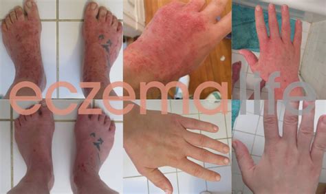 Eczema Treatments Before And After Eczema Life
