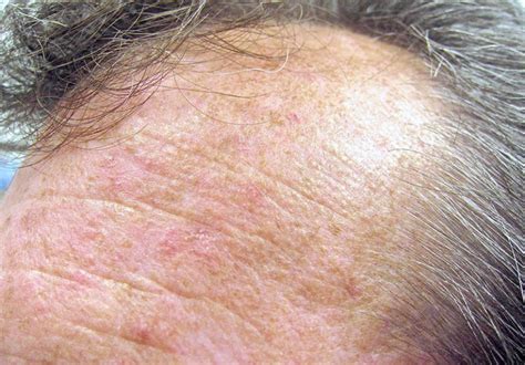 10 Best Actinic Keratosis Home Treatment
