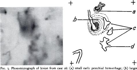 Figure 3 From The Mechanism Of Petechial Hemorrhage Formation