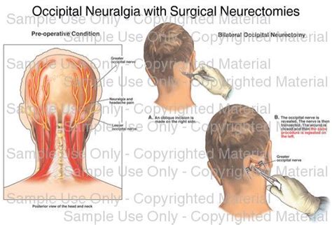 Occipital Neuralgia Surgical Neurectomies Occipital Neuralgia