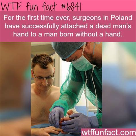 Polish Surgeon Attach A Dead Mans Hand To A Man Fun Facts Wtf Fun