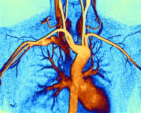 Digital Subtraction Pulmonary Angiography In Children With Ph Due To