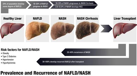 Nafld Epidemiology Emerging Pharmacotherapy Liver Transplantation