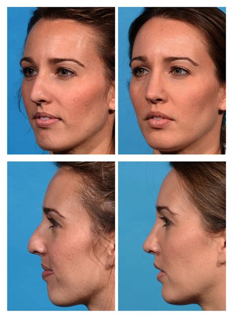 Rhinoplasty Before And After Photos