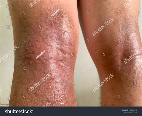 Back Knees Atopic Eczema Causes Areas Stock Photo Edit Now 1422066512