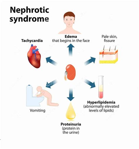 Ascites In Nephrotic Syndrome