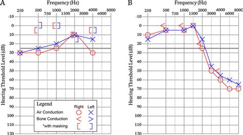 Fig 2 A Audiogram Illustrating A Bilateral Conductive Hearing Loss