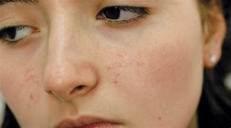 Home Remedies For Acne Scars And Dark Spots Beauty Station
