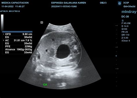 Embarazo Intrauterino Médica Capacitación