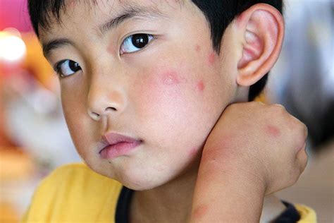 13 Penyebab Kulit Gatal Bentol Seperti Digigit Nyamuk