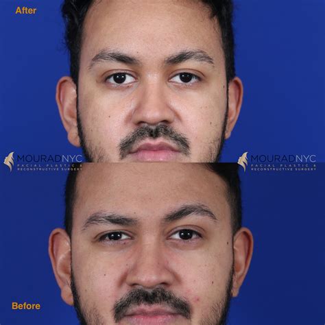 Male Brow Lift Before And After Facial Plastic Surgeon