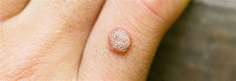 How To Get Rid Of Warts Naturally With Home Remedies Yeyelife