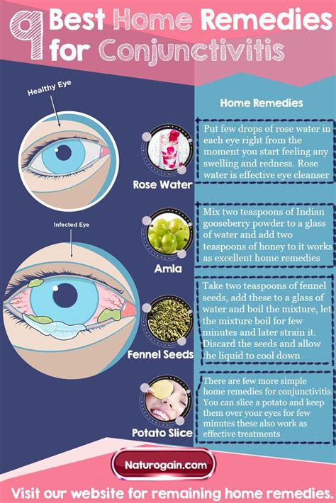 Home Remedies For Conjunctivitis Onepronic