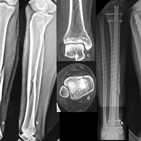 A B Ap And Lateral Radiographs Showing An Aoota 42a1 Fracture In