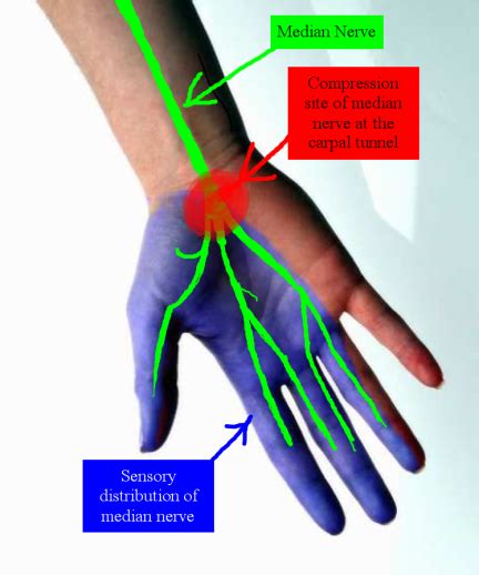 Pain In Thumb Index And Middle Finger Geigade