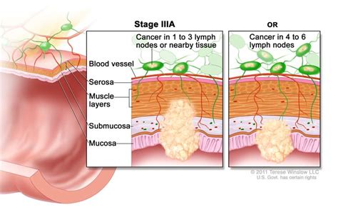 Rectal Cancer Hematology Oncology Associates Of Cny
