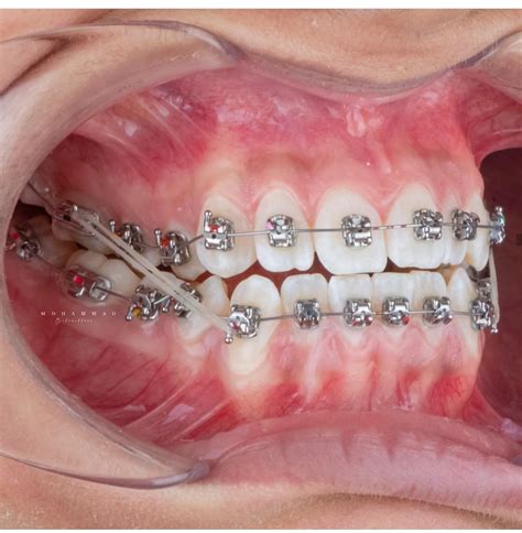 Pin By John Beeson On Rubber Bands Braces Colors Dental Braces