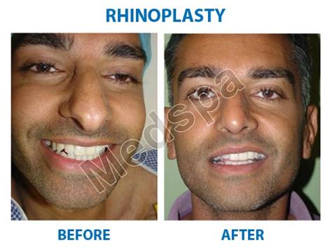 Best Rhinoplasty Surgery In Delhi Nose Surgery Cost In India