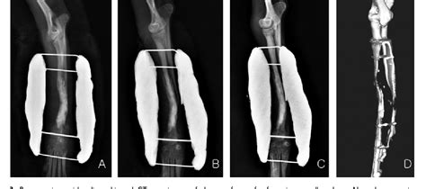 Figure 3 From Use Of Porcine Cancellous Bone Graft Of Radial Nonunion