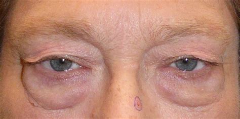 Lower Eyelid Blepharoplasty Before And After The Aesthetics Center