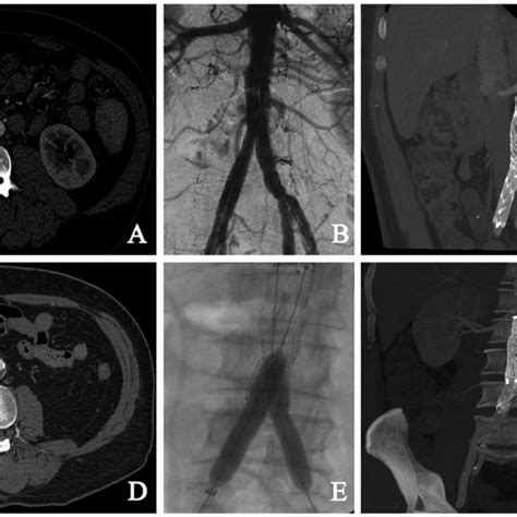 Pdf Endovascular Treatment Of Spontaneous Isolated Abdominal Aortic