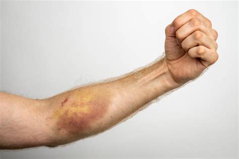 1127 Arm Bruise Photos Free And Royalty Free Stock Photos From Dreamstime