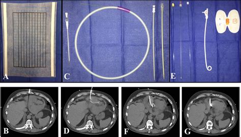 Computed Tomography-guided Pericardiocentesis: An alternative approach ...
