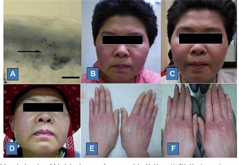Figure 1 From Effectiveness Of Botulinum Toxin A In Treatment Of