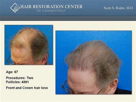 Fue Hair Transplant Hair Restoration Hartford Ct