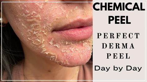 Chemical Peel Perfect Derma Peel Day By Day Post Procedure By