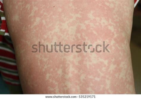 221 Maculopapular Rash Images Stock Photos 3d Objects And Vectors