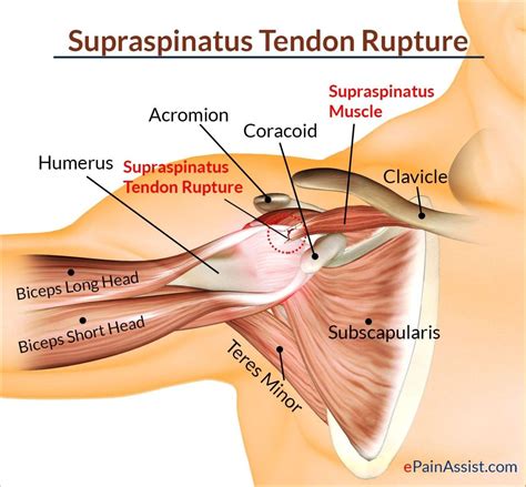 Following inferior dislocation of shoulder joint, the rounded contour of shoulder is lost and there is weakness of abduction of armbecause the axillary nerve is likely to be injured in the inferior. Diagram Of Shoulder Tendons Muscles Ligaments And Tendons Of The Human Back Nerd Pinterest ...