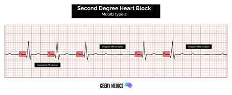 How To Read An ECG ECG Interpretation EKG Geeky Medics