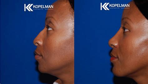 Chin Implant Before And After Gallery Plastic Surgery With Dr Kopelman
