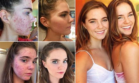 nina and randa nelson on how they conquered cystic acne with vegan diets daily mail online