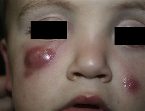 Asymptomatic Erythematous Violaceous Nodular Lesions In The Lower Right